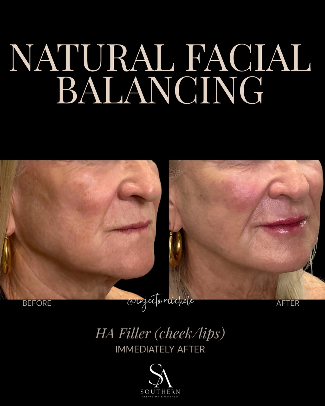 Original cheek and lip filler comparison labelled before and immediately after treatment.
