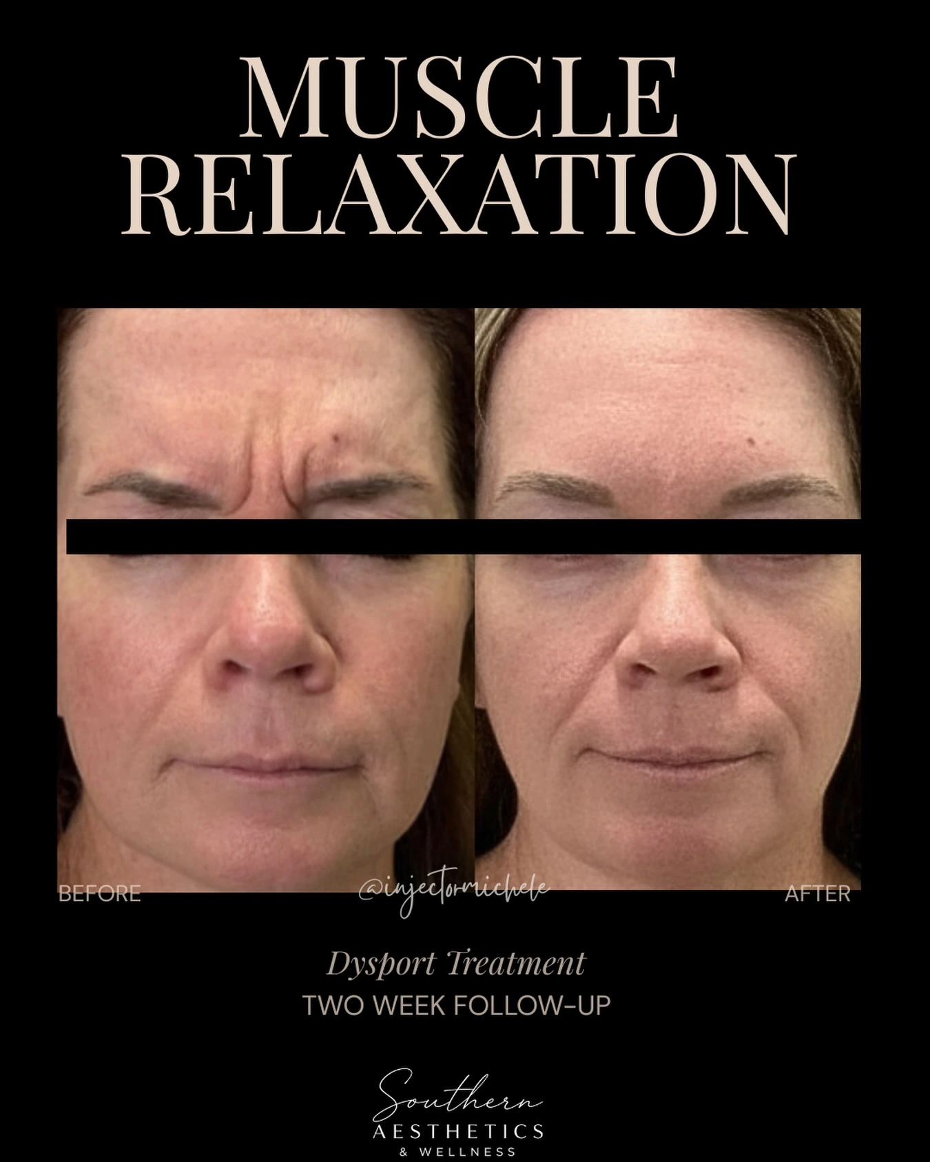 Original Dysport frown-line comparison, with eye masking and a two-week follow-up label.
